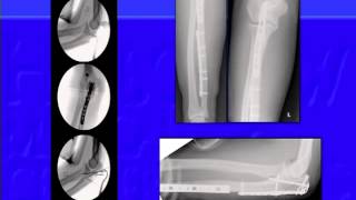 Complex Forearm Fractures [upl. by Grantland772]