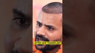 Youtuber Topa Bhai  Nadeem Bunny  Hair Transplant Progress shortshairtransplant [upl. by Ydor]