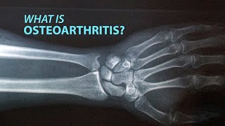 What is Osteoarthritis [upl. by Littell]