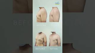 Gynecomastia Surgery Before After Celebre Aesthetics Transformation [upl. by Medorra]