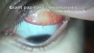 Giant papillary conjunctivitis [upl. by Anitsirhcairam]