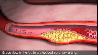 Angina and coronary heart disease [upl. by Sauder]