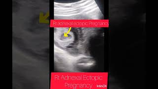 Ultrasound showing Ectopic PregnancyRt Adnexal Ectopic Pregnancyviralshortyoutubeshortsbabyuk [upl. by Osman]