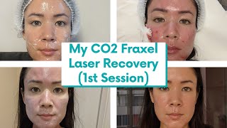 I FINALLY Got CO2 Fraxel Laser for my Atrophic Acne Scars Recovery Vlog  michxmash [upl. by Yrret]