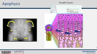 Hip and Pelvis Apophysitis [upl. by Hachmin]