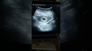 Case of bicornuate uterus with pregnancy [upl. by Adriane]