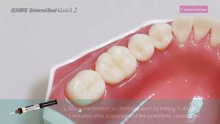 How to with UBQ 2 Cementation of Indirect Restorations [upl. by Haleak]