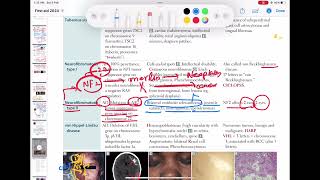 Neurofibromatosis type 2 neurology 122  First Aid USMLE Step 1 in UrduHindi [upl. by Leoline113]