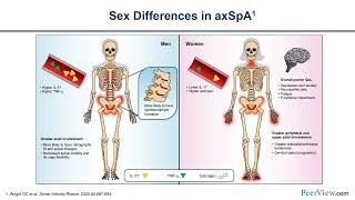 Recognition and Management of Axial Spondyloarthritis Best Practices for Family Medicine Physicians [upl. by Balduin]