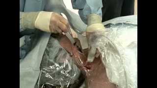 Placement of Central Venous Catheter  NEJM [upl. by Gena]