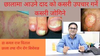 daaj medicine dabai ringworm treatment in nepali fungal skin infections in nepal Dr kamal Dhital [upl. by Cristi981]