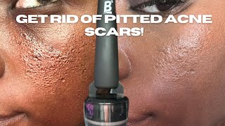 HOW TO GET RID OF PITTED ACNE SCARS [upl. by Handel631]