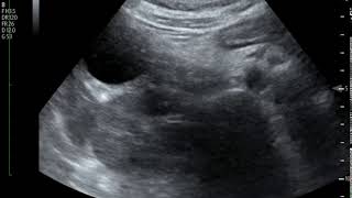 Acute Cholecystitis Ultrasound JETem 2018 [upl. by Eriha]