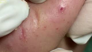 Relax with Remove Acne Video On Acne Treatment Ngoc Can Tho Channel 005 [upl. by Scrivings]