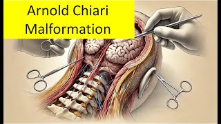 Arnold Chiari Malformation [upl. by Einahpetse]