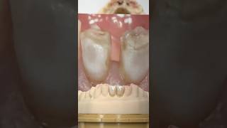 Closing the diastema ​⁠EnvisiontecMain envisiontec lsk121shorts dentist teethsmile [upl. by Adnhoj]