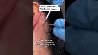 Skin Tag Removal With Radiofrequency  Quick amp Safe Treatment DRMEDISPA [upl. by Lahcym]