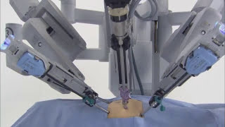 da Vinci® Robotic Surgical System [upl. by Goddord]