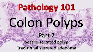 Colon Polyps  Part 2  Pathology 101 [upl. by Arty]