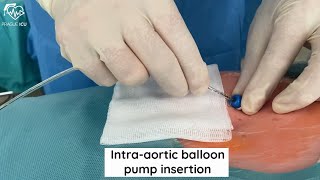 Intraaortic balloon pump insertion [upl. by September]