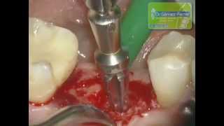 Implante Dental en Valencia Implante Unitario Molar [upl. by Pain110]