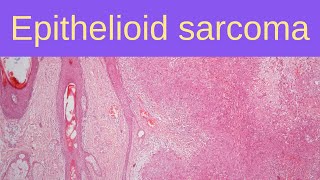 Epithelioid Sarcoma  Pathology mini tutorials [upl. by Yelsew]