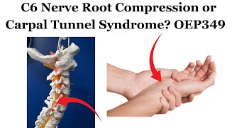 C6 Nerve Root Compression or Carpal Tunnel Syndrome  OEP349 [upl. by Lunnete]