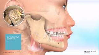 Carriere® Motion™ Appliance for Class II Patient Education Animation [upl. by Wavell]