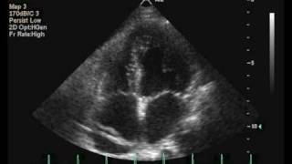 Interatrial septal aneurysm [upl. by Eleanor]