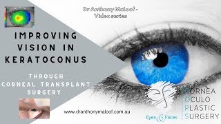 Improving vision in Keratoconus through corneal transplant surgery Dr Maloof Sydney Australia [upl. by Kristy]