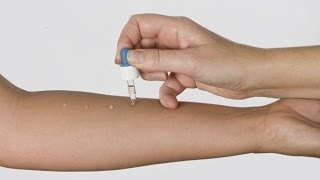 Allergie pediatriche diagnosi con il prick test  Centro Medico Santagostino [upl. by Annait]