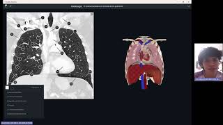 Tomografía de tóraxRadiant [upl. by Notselrahc]