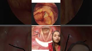 Endoscopic image of laryngeal growth larynx growth ent educational [upl. by Eelarbed]