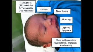 Respiratory distress and respiratory distress syndrome in newbornRDS रेस्पिरेटरी डिस्ट्रेस सिंड्रोम [upl. by Nolahc175]