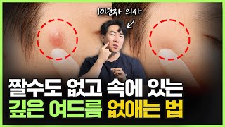 짤수도 없고 속에서 만져만지는 여드름 이렇게 해결하세요ㅣ지긋지긋한 여드름 없애는 법 좁쌀여드름부터 화농성 여드름 모낭염 피지낭종까지 전부 알려드립니다 [upl. by Corder]