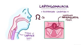 Laryngomalacia causes symptoms diagnosis treatment pathology [upl. by Eelyahs]