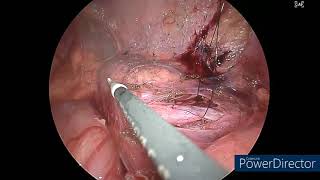 Laparoscopic ureteroureterostomy for mid ureteric obstruction [upl. by Cirdes325]