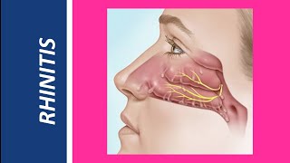 Rhinitis AcuteViral rhinitis Allergic rhinitis Nonallergic rhinitis Atrophic rhinitis [upl. by Maida]