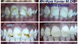 Teeth whitening Dental Bleaching  Dental fluorosis [upl. by Mcmaster173]