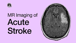 MR Imaging in Acute Stroke Basics [upl. by Kirimia]