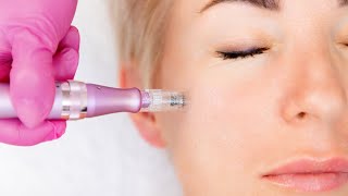 Achieve Smooth Youthful Skin with SkinPen Microneedling in dallastx [upl. by Eycal]