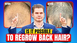 Can Completely Bald Regrow hair [upl. by Canon260]