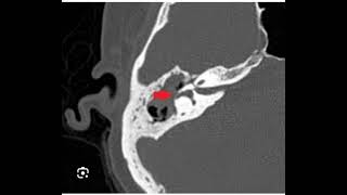 Perilymph Fistula [upl. by Gellman203]