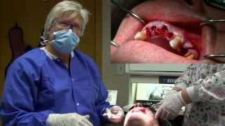 Physics Forceps Immediate Implant Placement Grafting tooth extraction overdenture [upl. by Ahseem268]