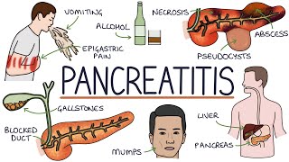 Understanding Pancreatitis [upl. by Sillyhp]