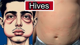 Hives Urticaria Explained Allergies Triggers and Relief Strategies [upl. by Panter]