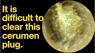 It is difficult to clear this cerumen plugear wax removal  ear cleaning  ASMR  relaxation [upl. by Asinet297]