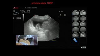 ipertrofia prostata sottoposta a TURP [upl. by Ledarf]