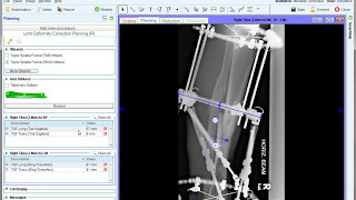 Taylor Spatial Frame TSF Assessment  Deformity Correction Planning  Materialise OrthoView [upl. by Nylg]