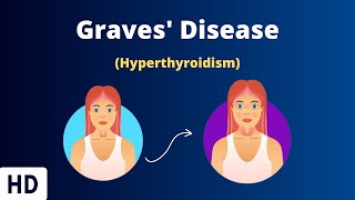 Graves Disease Everything You Need To Know [upl. by Woodie415]